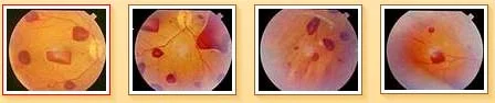 emorragiadaipotonocaso1