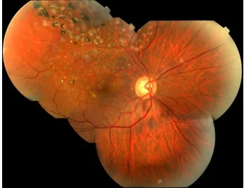 esitiOcclusione