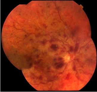 occlusione
