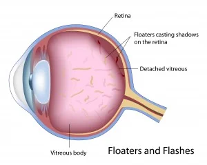 Floaters o mosche volanti