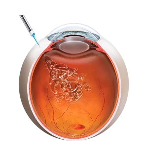 Iniezione occhio intravitreale