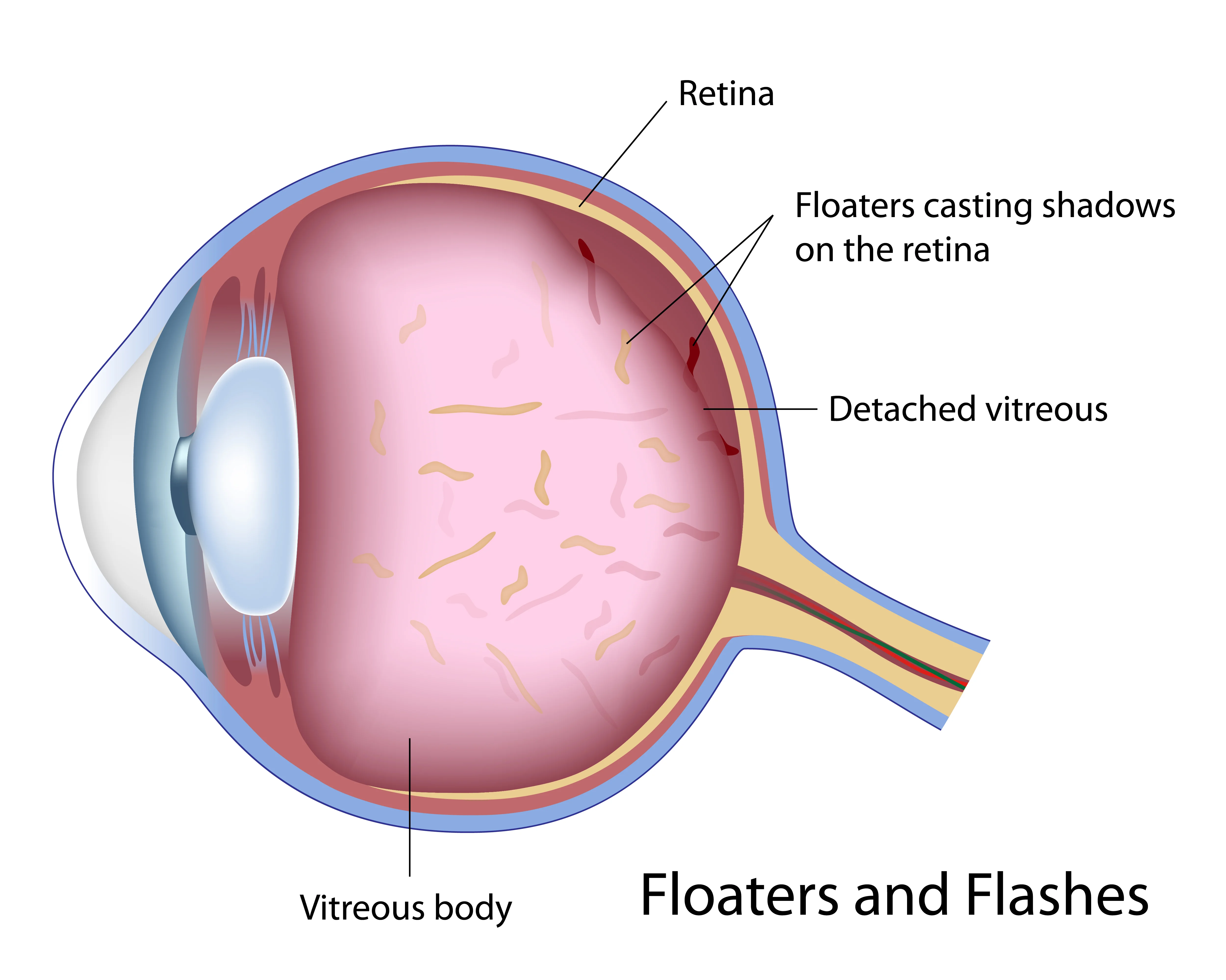 Floaters o mosche volanti