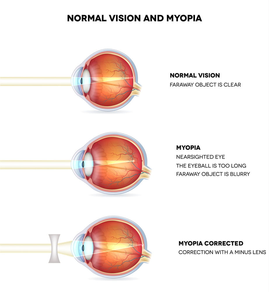 myopia ok terápia